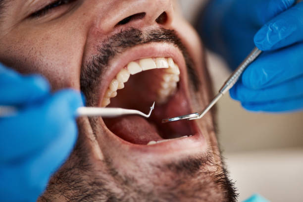 Best Emergency Dentist for Lost Fillings or Crowns in Robesonia, PA